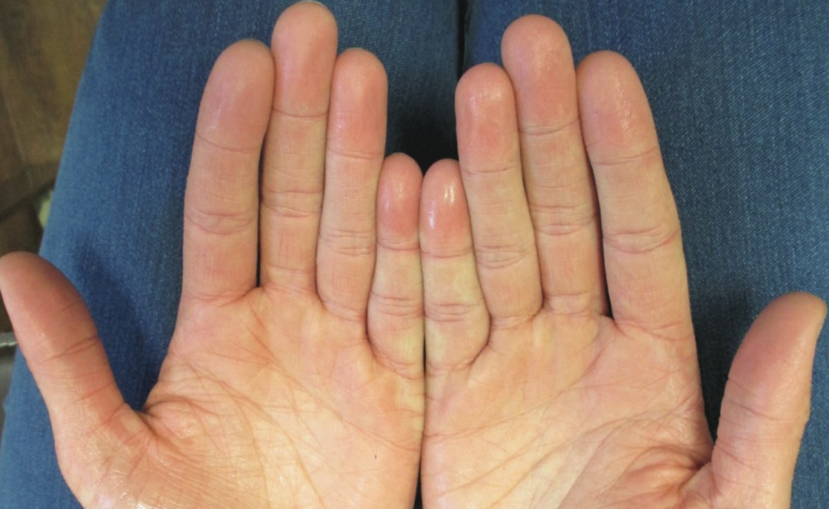 Hyperhidrosis hands getting assessed.