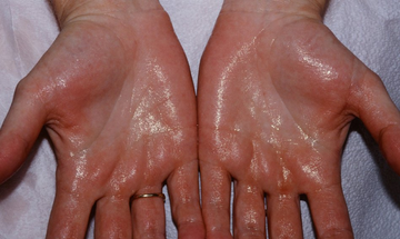 Close-up of sweaty palms showing hyperhidrosis