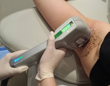 Clinician treating a patient’s underarm with a handheld device for hyperhidrosis