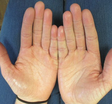 Open palms with visible moisture, illustrating hand hyperhidrosis