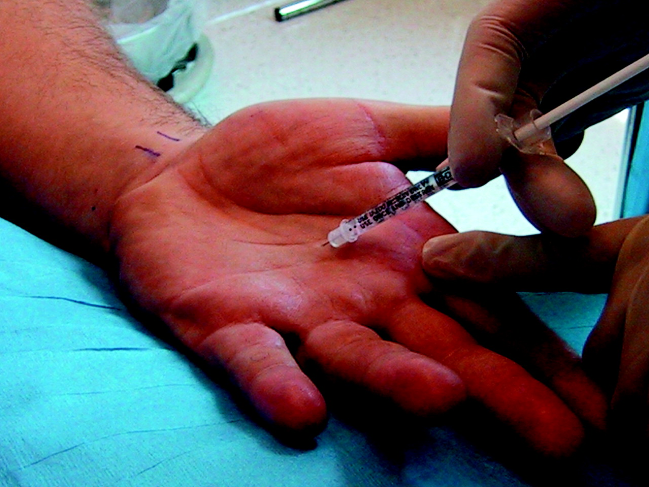 hyperhidrosis treatment protocol