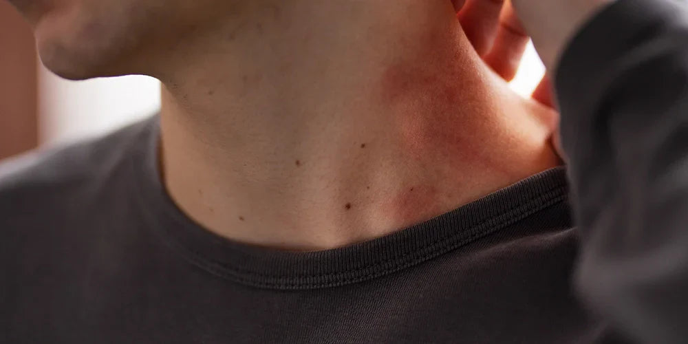 a young man dealing with sweat hives