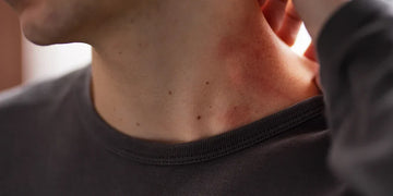 a young man dealing with sweat hives